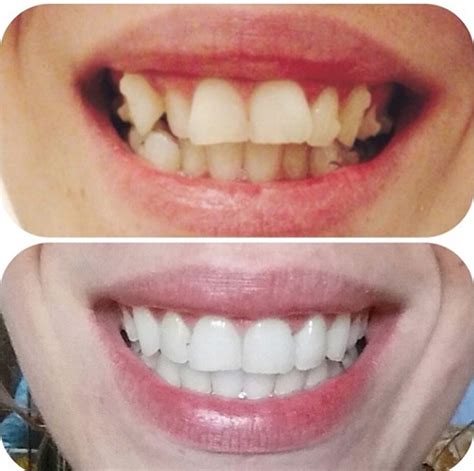 Pin on Clear Braces and Invisalign