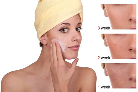 Acne Before and After Using Benzoyl Peroxide Persol Gel – Cosmetics and you : Acne Treatment ...