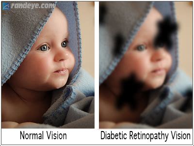 Diabetic Retinopathy – Diabetes | Rand Eye Institute