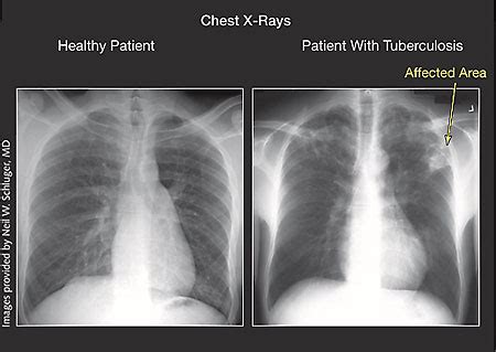 Tuberculosis | Infectious Diseases | JAMA | The JAMA Network