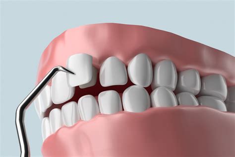 Types of Dental Veneers | Enhance Your Smile’s Appearance