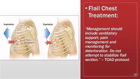 Chest trauma ppt for lems