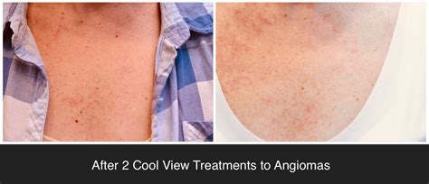 Laser Treatment for Cherry Angiomas for Hamilton Square, NJ | Kessel Dermatology | Board ...