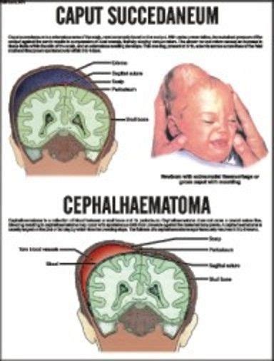 Caput Succedaneum, Cephalhaematoma Chart | Neonatal nurse, Pediatric nursing, Nursing school ...