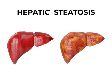 What Causes Hepatic Steatosis? | Ben Crump Law, PLLC