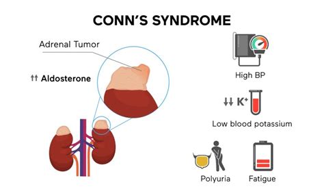 Endocrine Hypertension: What You Need To Know - SOG Health Pte. Ltd.