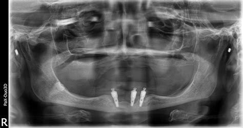 Complications-Bone Graft For Failed Full Lower Dental Implants