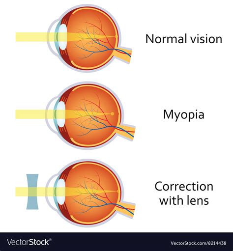 Myopia and corrected by a minus lens Royalty Free Vector