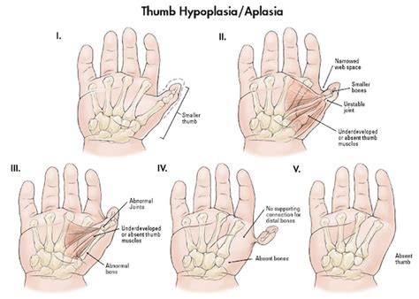 Thumb hypoplasia causes, classification, diagnosis & treatment