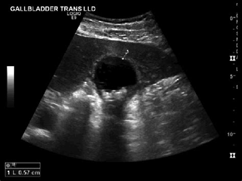 Gallbladder Wall Measurement Ultrasound