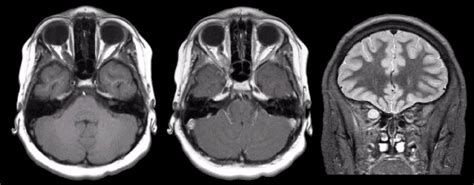 Optic glioma