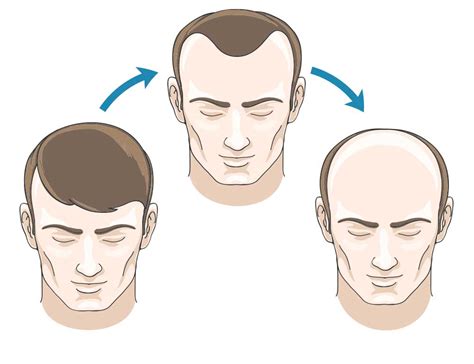 Mature or receding hairline - Treatment options with hair transplants ...