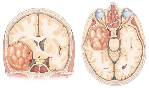 Olfactory Groove and Sphenoid Wing Meningiomas | Altair Health