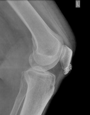 Calcific prepatellar bursitis | Radiology Case | Radiopaedia.org