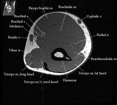 Elbow Anatomy Mri - Anatomical Charts & Posters