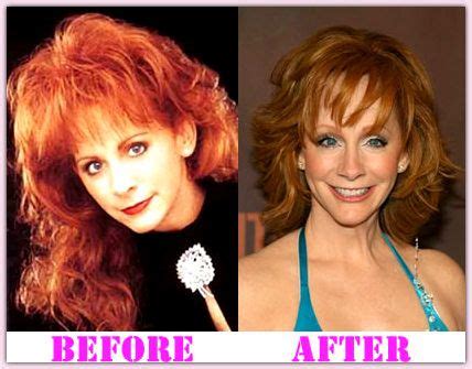 Reba Mcentire Plastic Surgery Before And After #RebaMcentireplasticsurgery #RebaMcentire # ...