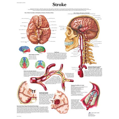 3B Scientific Stroke Chart