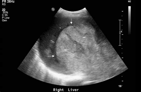 Large Hepatocellular Carcinoma | Radiology, Ultrasound, Large