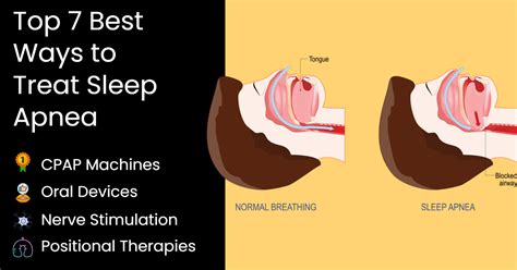 Best Devices for Sleep Apnea: Here's What Works in 2023 - CPAP.com Blog