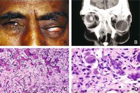 Boneforming Lesions Osteoma - Orbital Tumors - ALPF Medical Research