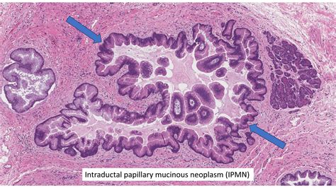 導管內胰臟黏液性腫瘤（IPMN）| 我的病理報告.ca