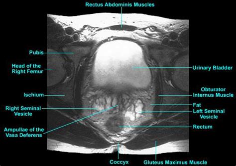 Prostate Surgery