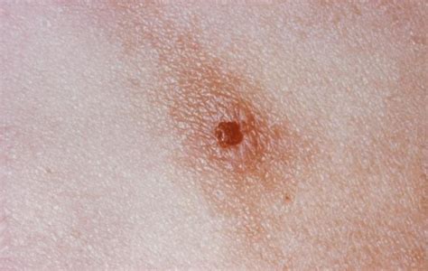 Gonorrhea symptoms skin - videogaret