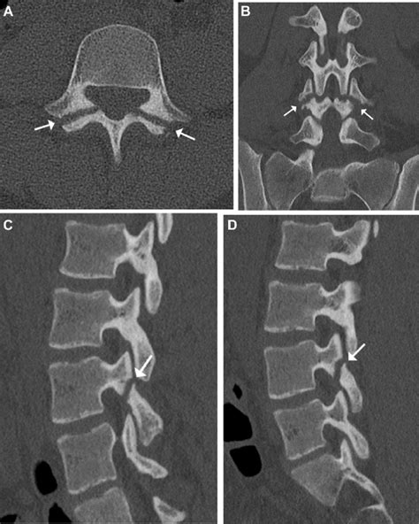 Bilateral L4 pars defect (arrows) on computed tomography (CT). (A ...