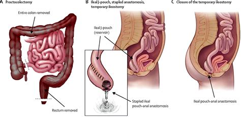 Pouchitis, Chronic Pouchitis - Causes, Symptoms, Treatment