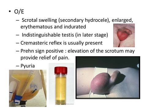 Acute vs chronic scrotal swelling