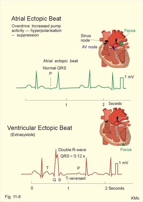 Atrial and ventricular ectopic beats | Nursing / Medical | Pinterest | Book, Physiology and Beats