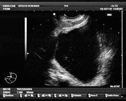 Endoscopic Ultrasound of the Colon | Radiology Key