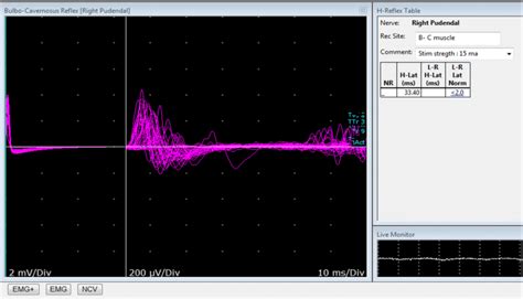 Bulbocavernosus reflex study. The response is recorded from the... | Download Scientific Diagram