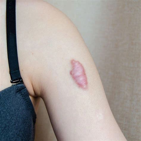 INDICATION-KELOID SCARS - Everlastwellness