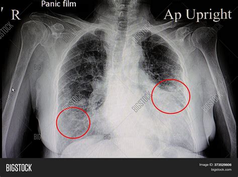 Cardiomegaly X Ray - tacitceiyrs