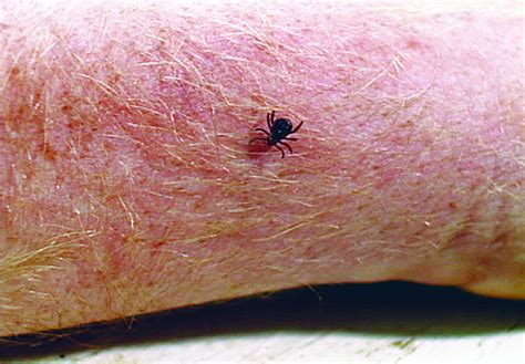 Tick-Borne Relapsing Fever: Clinical Manifestations, Diagnosis ...