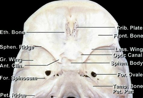 Medial Sphenoid Wing Meningioma | The Neurosurgical Atlas, by Aaron Cohen-Gadol, M.D.