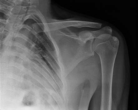 Greater tuberosity of humerus fracture | Radiology Case | Radiopaedia.org