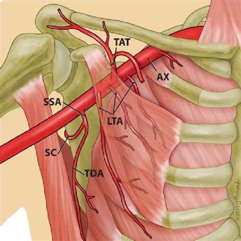 a type I-lateral thoracic branches (LTA) of the thoracoacromial artery ...