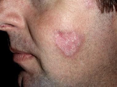 Discoid Lupus Erythematosus: Background, Etiology, Epidemiology