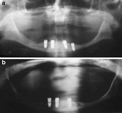 a Four implants inserted in edentulous mandible. b One implant was ...