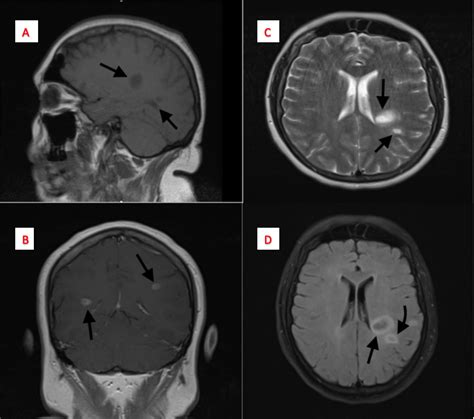 Brain Mri Scan Showing Multiple Sclerosis Lesions Mul - vrogue.co