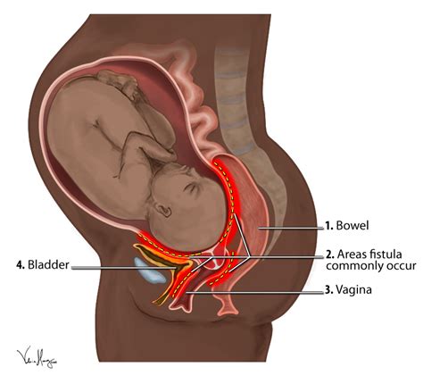 Obstetric fistula - Wikipedia