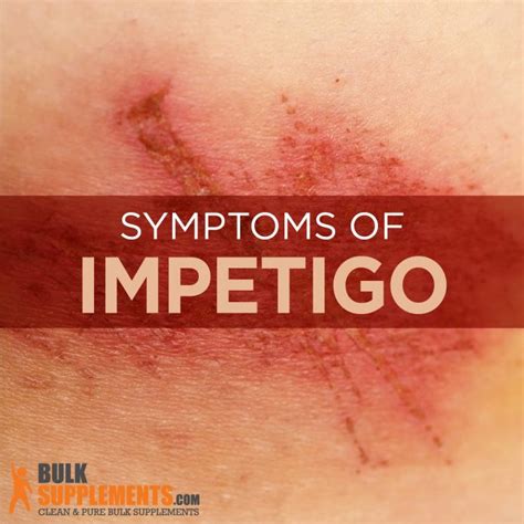 Impetigo - Symptom, Causes, Complications And Risk Factors