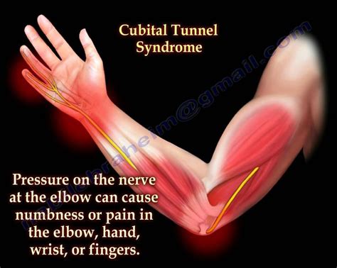 Cubital Tunnel Syndrome Ulnar Nerve Entrapment - Everything You Need To ...