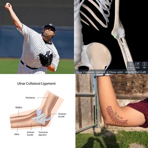 Tommy John vs UCL Repair — Armored Heat