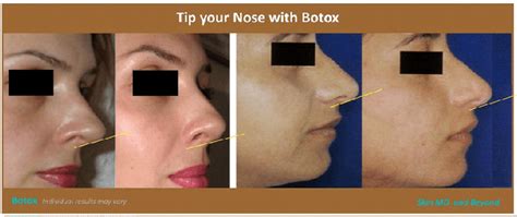 Botox Treatment in Plano, TX - Facial Fillers in Frisco, TX