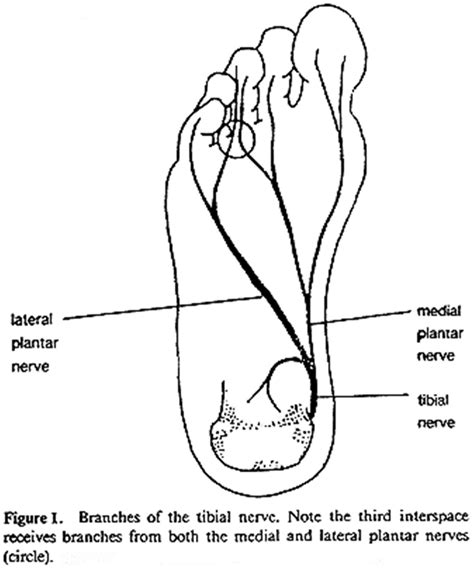 Morton's Neuroma Big Toe