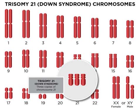 Trisomy 21 (Down Syndrome) | Cardinal Glennon