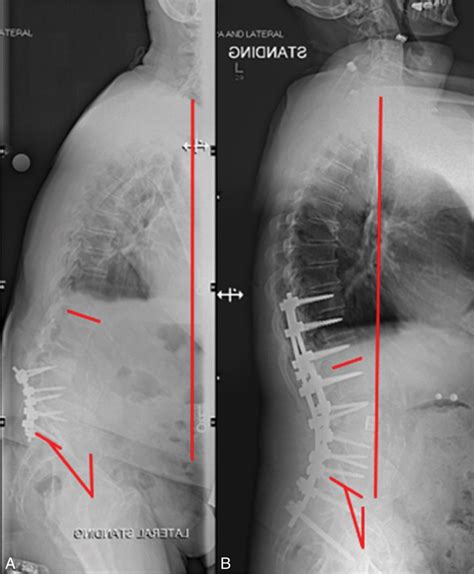 Pedicle Subtraction Osteotomy | Neupsy Key